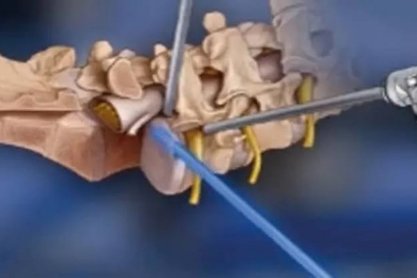 [Cirurgia endoscópica da coluna avança como alternativa menos invasiva para dor crônica! ]