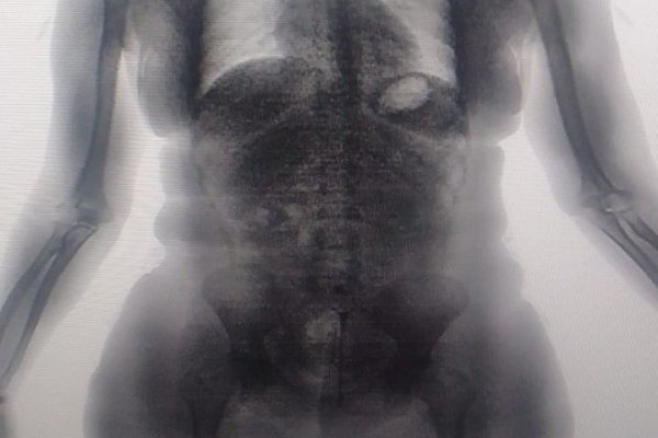 [Visitante é flagrada pelo BodyScan tentando entrar com drogas escondidas em presídio na RMS ]