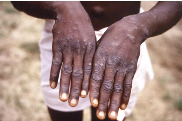 [Mpox: reconhecer sinais suspeitos e procurar atendimento precoce é fundamental, recomenda dermatologista! ]