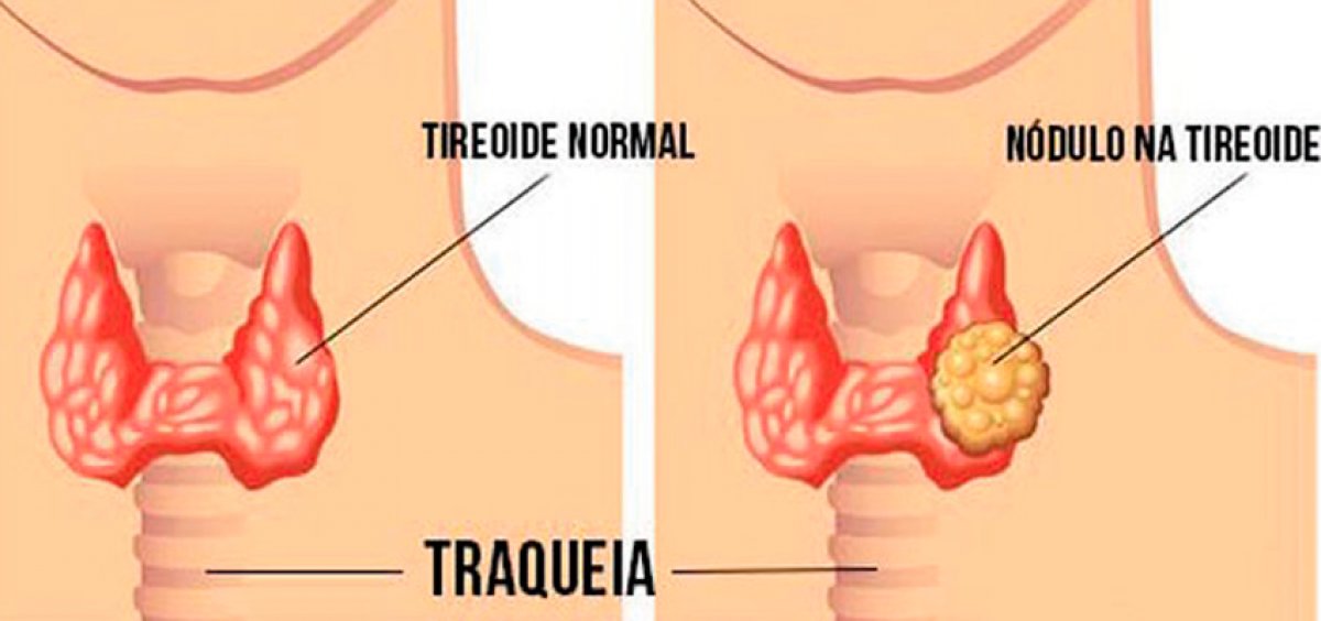 Nódulos na Tireoide