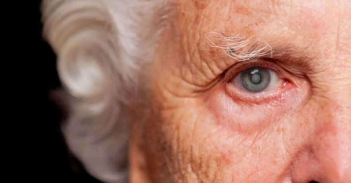 Oftalmologistas explicam como cirurgia de catarata também pode reduzir o risco de desenvolvimento de demências