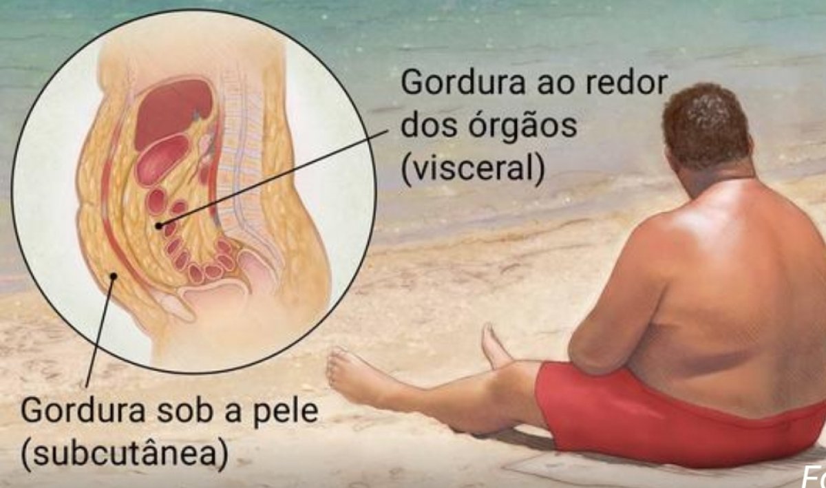 Obesidade
