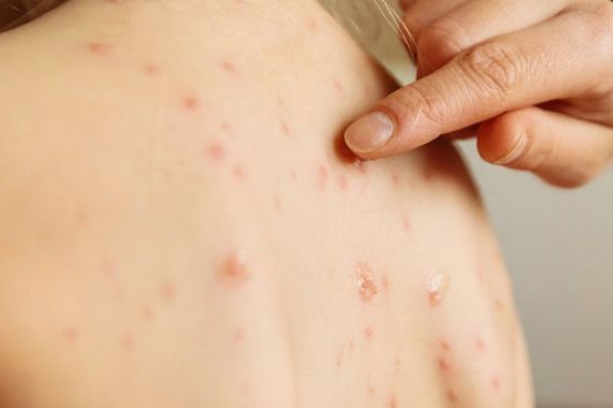 Número de casos de sarampo confirmados na Bahia sobe para 20