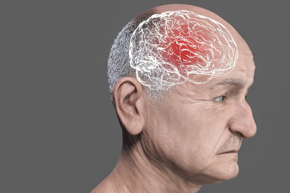 Pesquisadores projetam que até 2050 haverá mais de 153 milhões de pessoas com demência no mundo