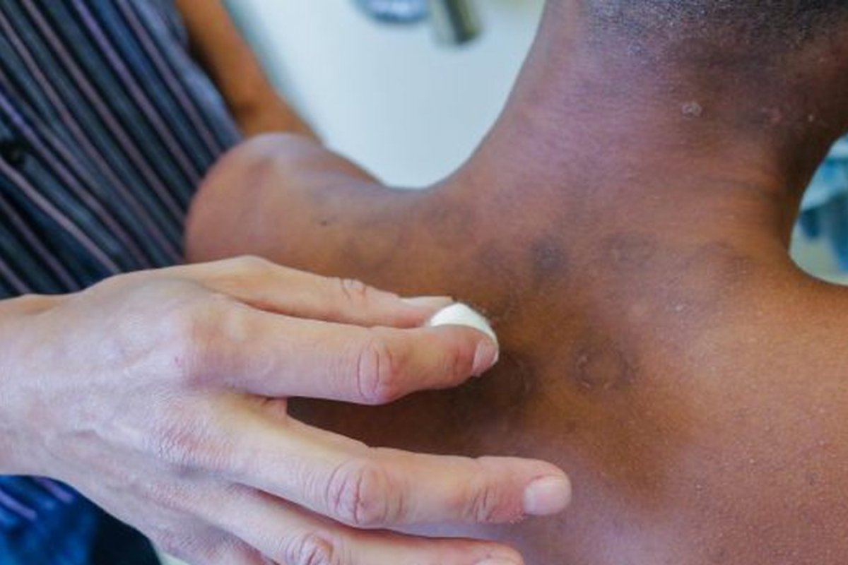 Campanha de combate à hanseníase alerta sobre prevenção da doença