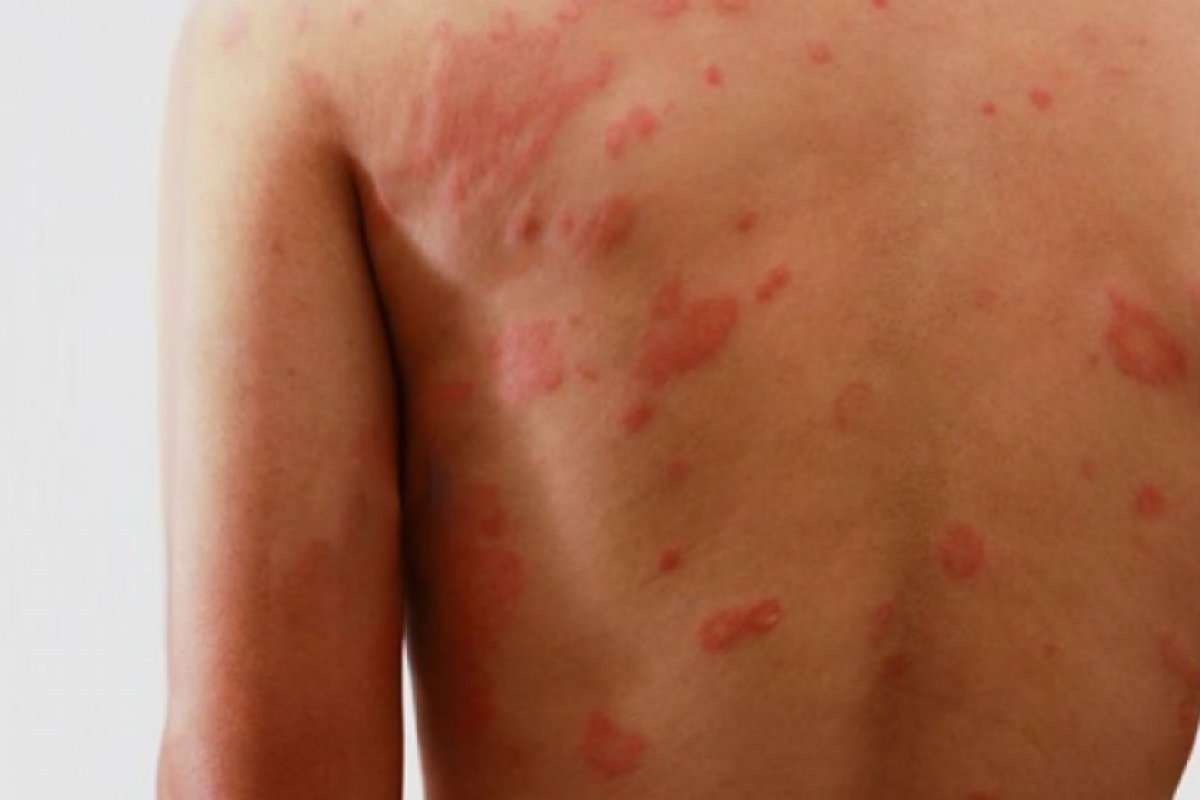 Notificações de hanseníase caem 57% devido à pandemia da Covid-19