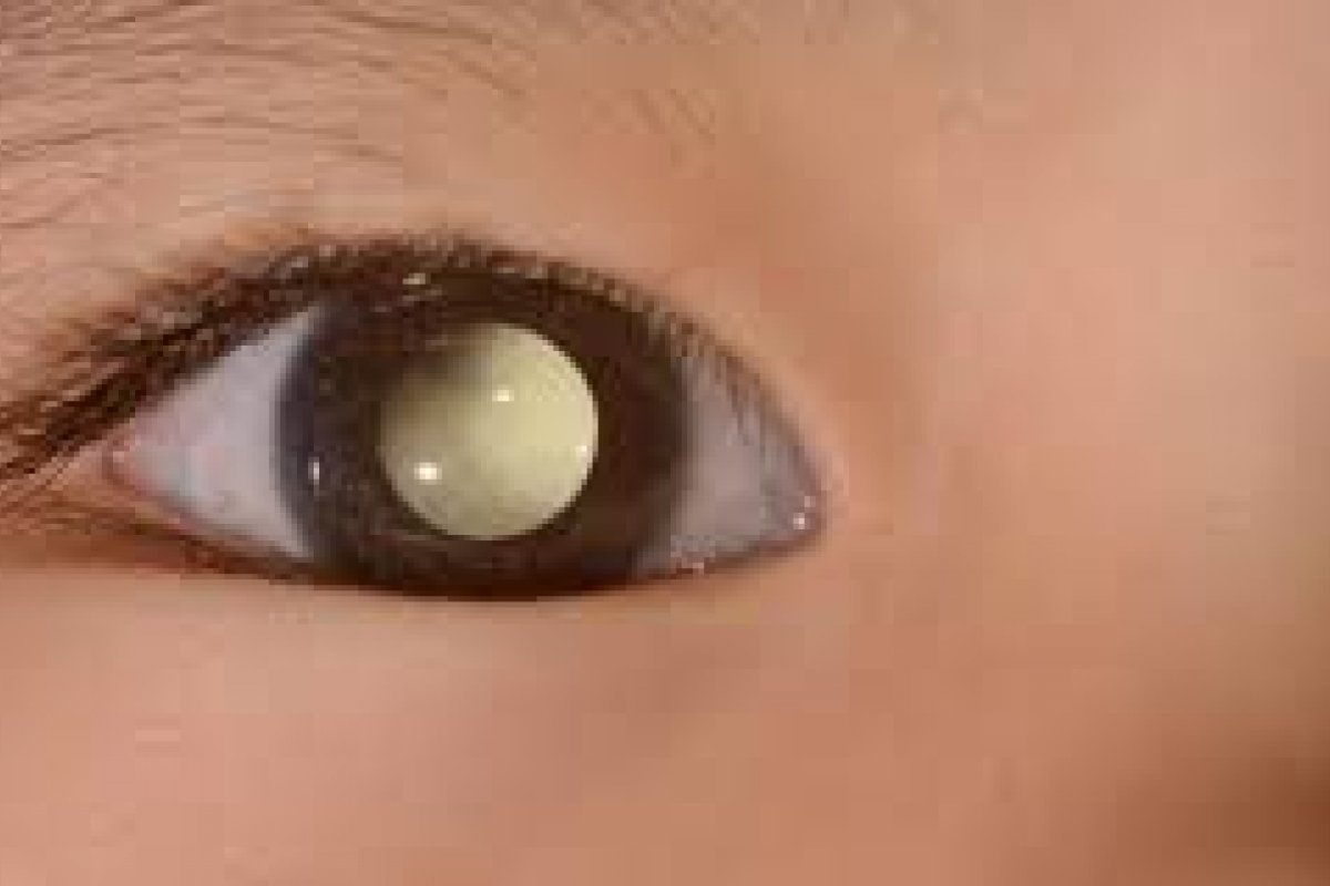 Podcast - Dia Mundial do Câncer e o Retinoblastoma