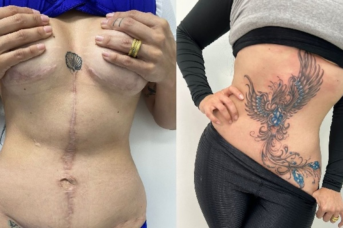 Projeto social ressignifica cicatrizes de mulheres através das tatuagens