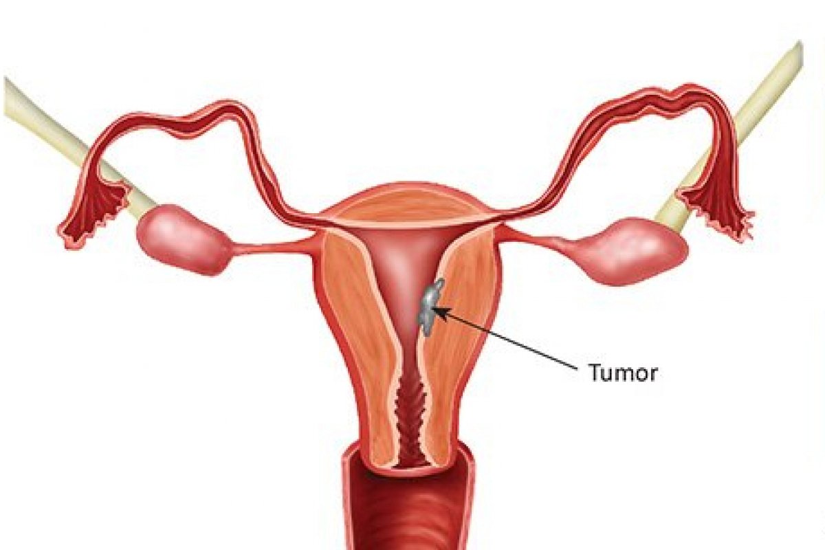 Câncer de endométrio tem tratamento que aumenta sobrevida das pacientes, afirma MSD