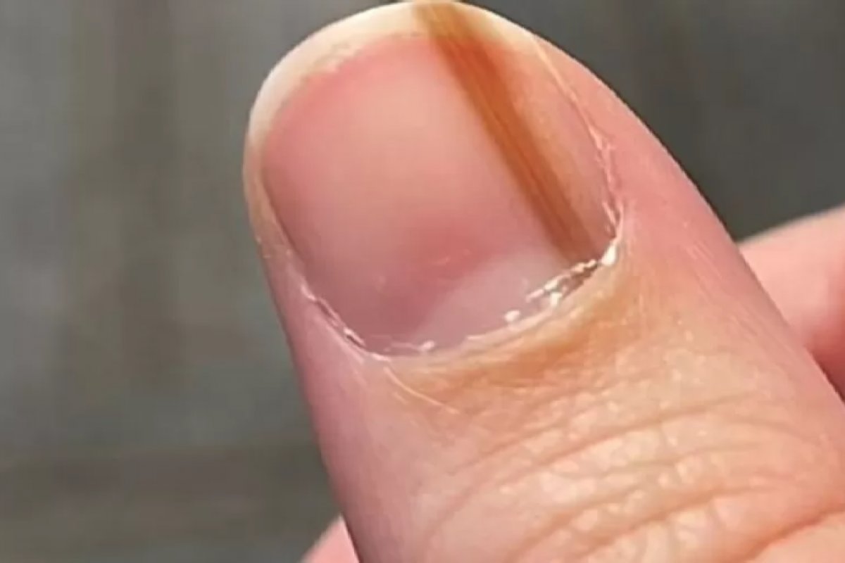 Vídeo: Vivendo por anos com mancha na unha, mulher descobre câncer