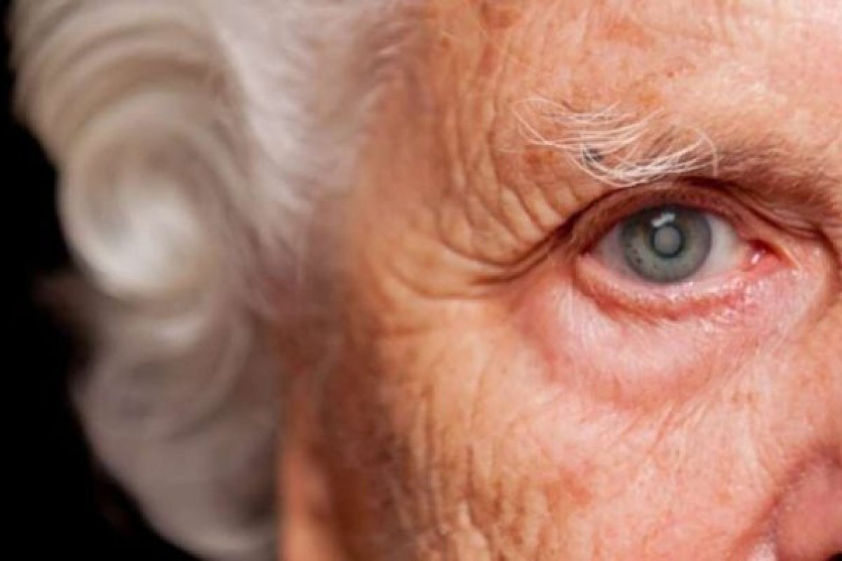 Oftalmologistas explicam como cirurgia de catarata também pode reduzir o risco de desenvolvimento de demências