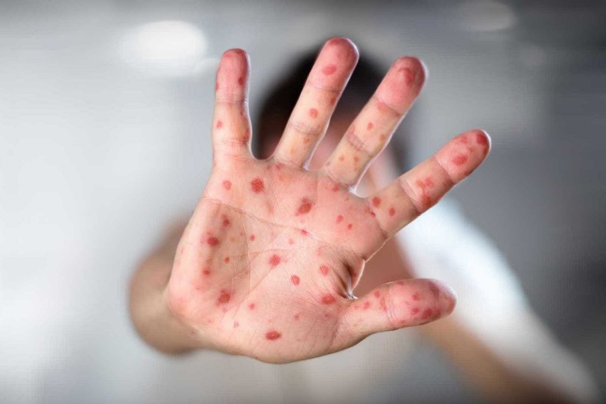 Unicef alerta para o retorno do sarampo e a poliomielite por baixa cobertura vacinal