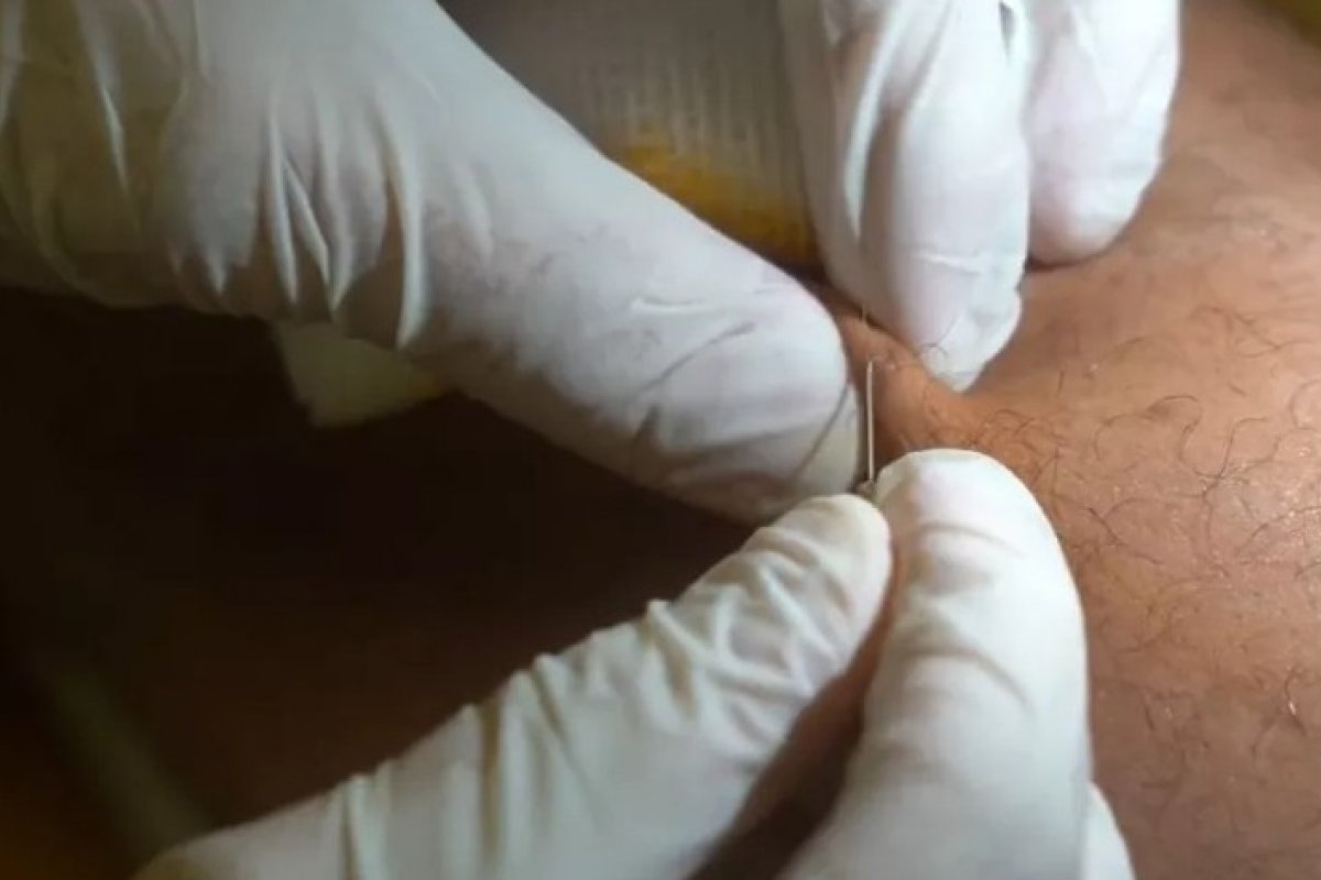 Após dois meses de atentado, Danilo Fernandes ainda retira estilhaços de vidro do corpo