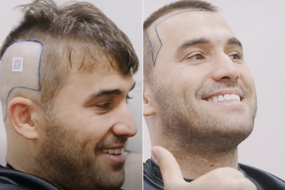 Tayrone se rende ao transplante capilar!