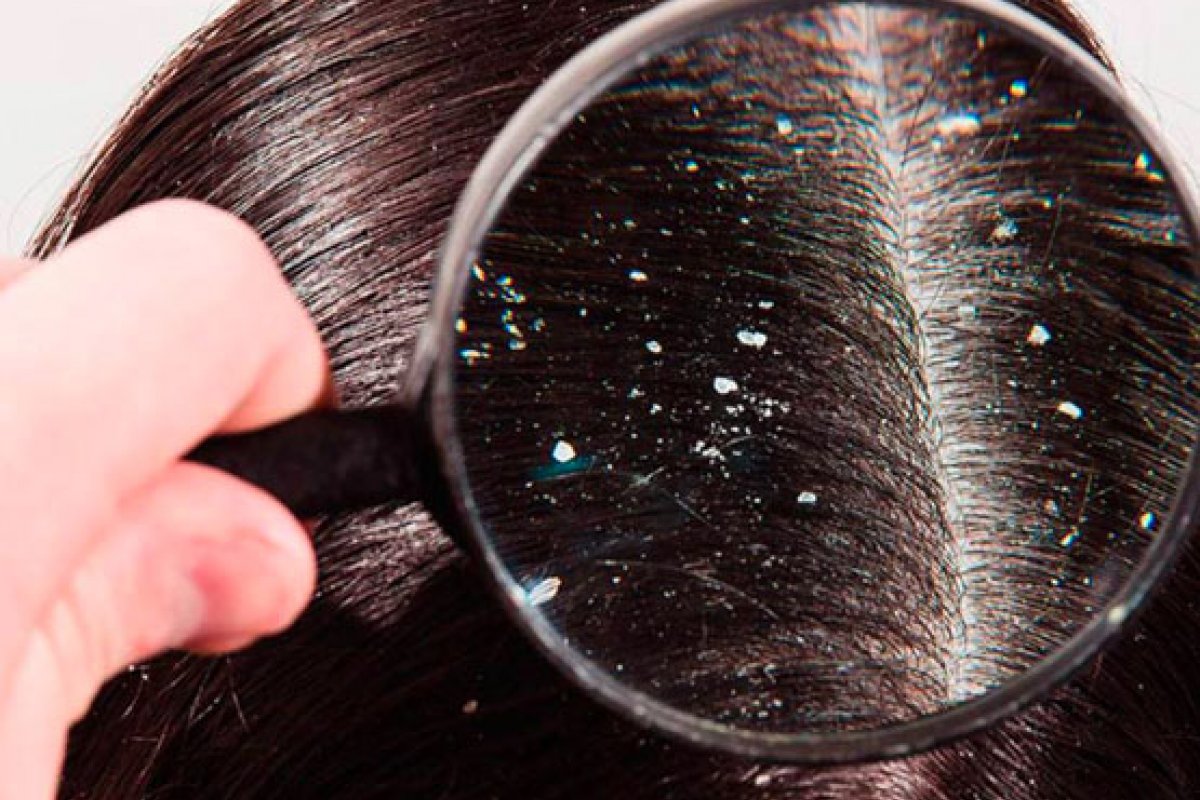 Nova linha de produtos combate a caspa sem ressecar os fios