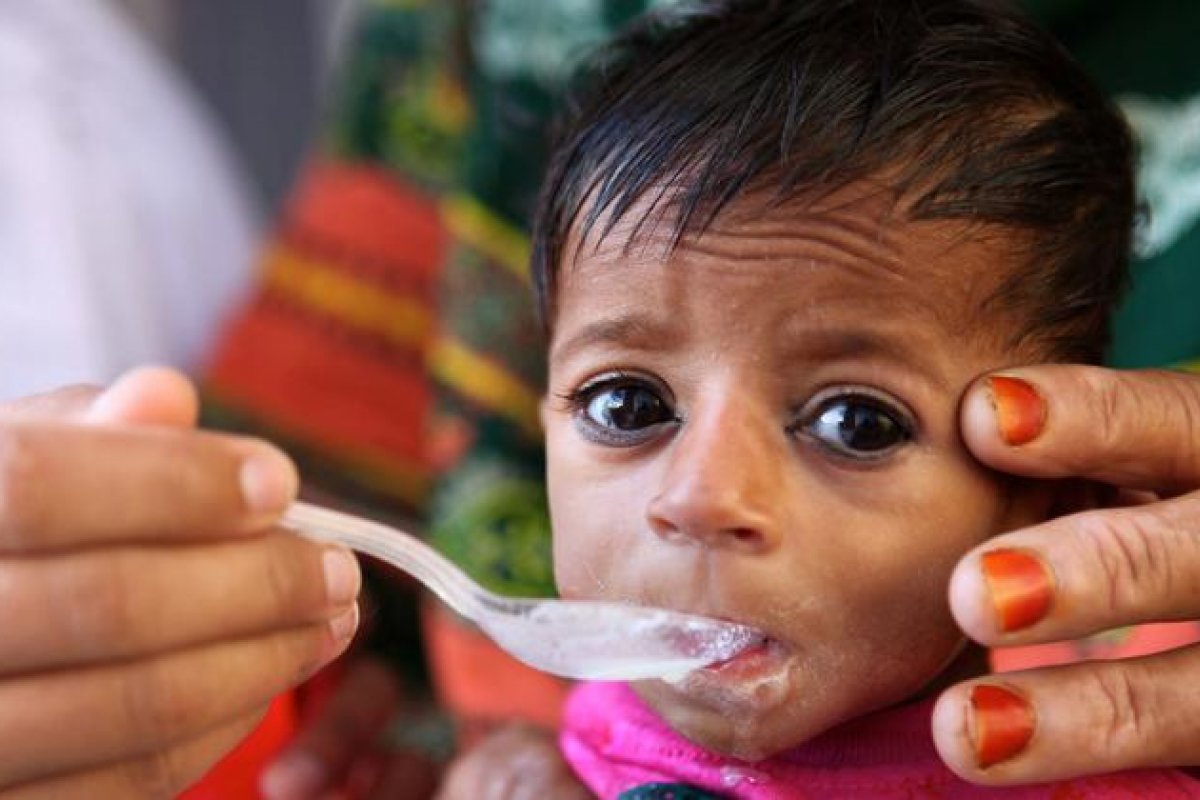 Unicef chama atenção para desnutrição severa infantil