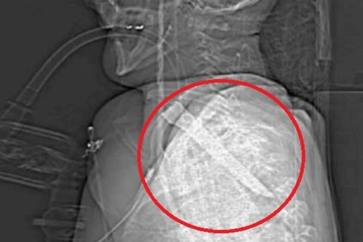 Homem sobrevive após ficar com uma lâmina de 14 cm presa na garganta