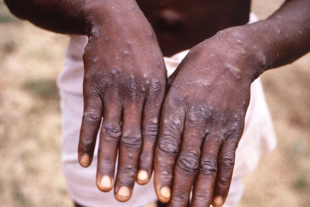 OMS registra 92 casos de varíola de macaco em 12 países