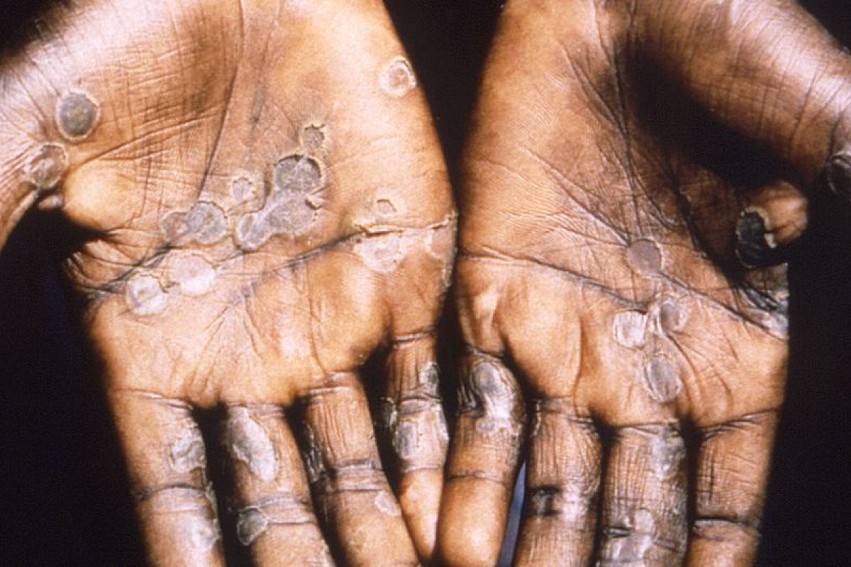 21 países têm casos confirmados da varíola dos macacos; confira lista