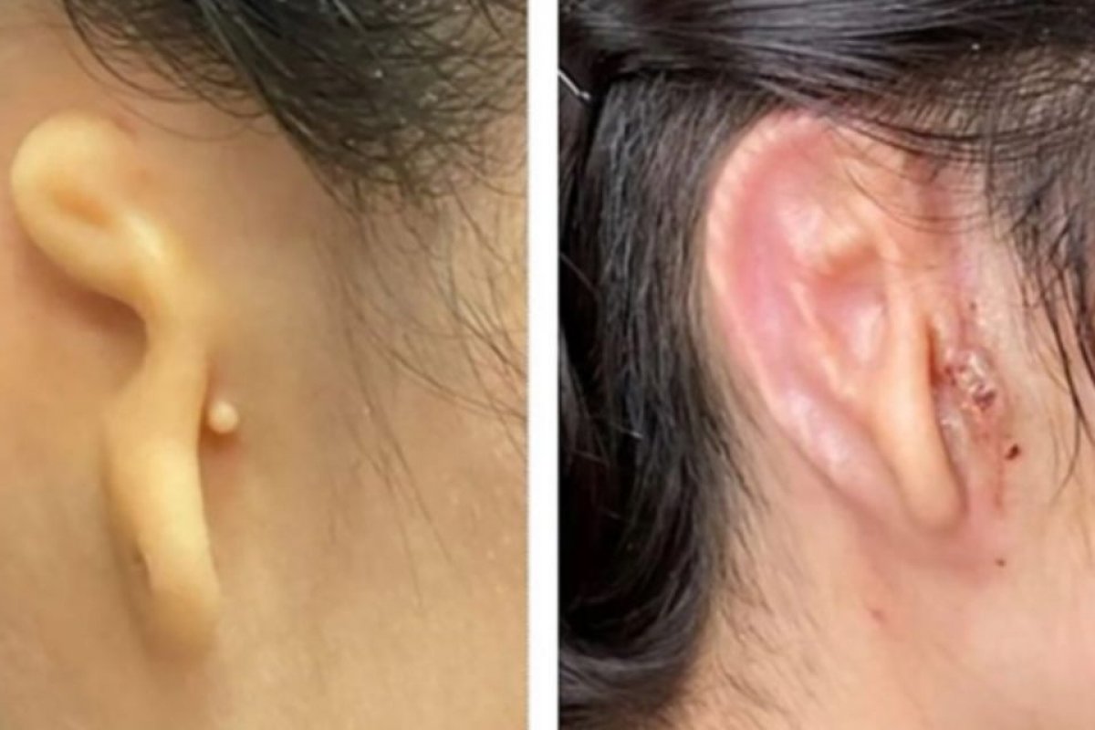 Cientistas fazem, pela 1ª vez, transplante de orelha impressa em 3D