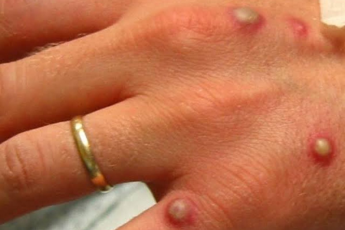 Ministério da Saúde monitora sete casos suspeitos de varíola dos macacos