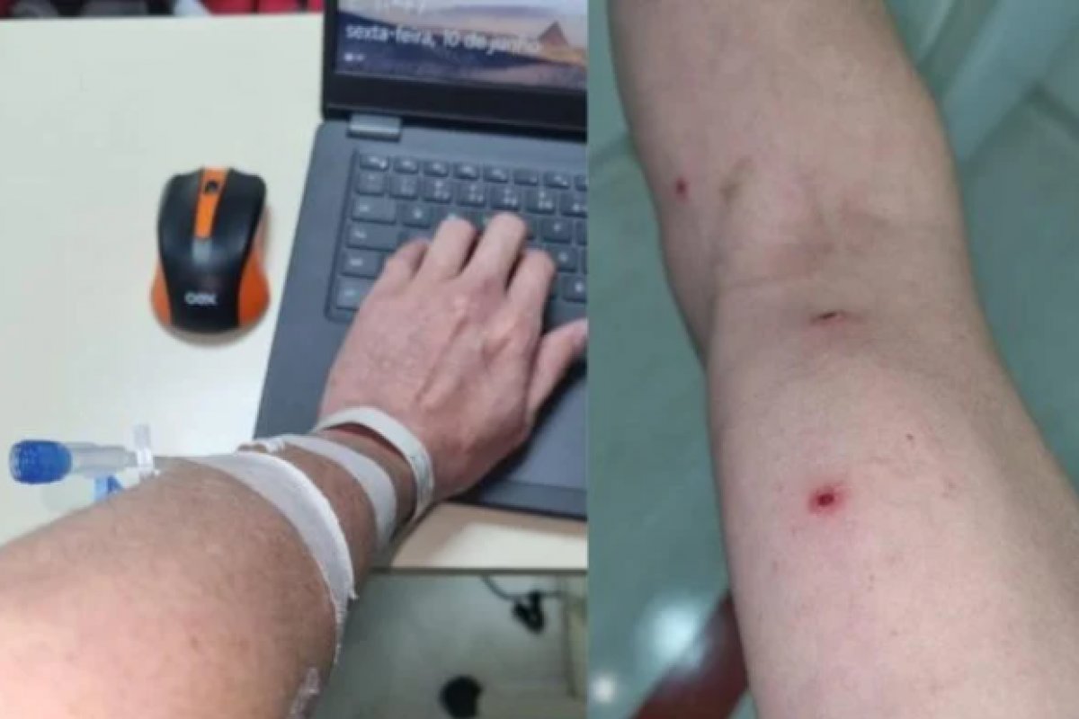 Brasileiro diagnosticado com varíola dos macacos diz que contou 60 feridas no corpo