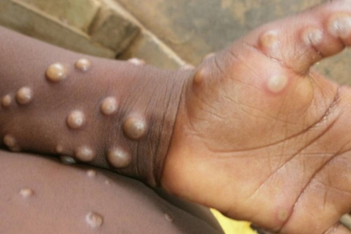 Ministério da Saúde confirma sexto caso de varíola dos macacos no Brasil