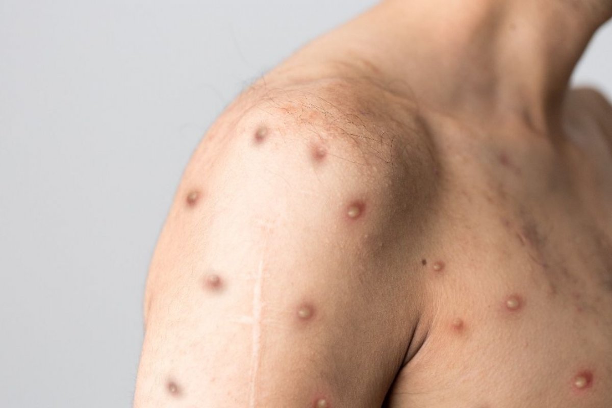 OMS recomenda medidas para tentar frear o rápido avanço da varíola do macaco; confira