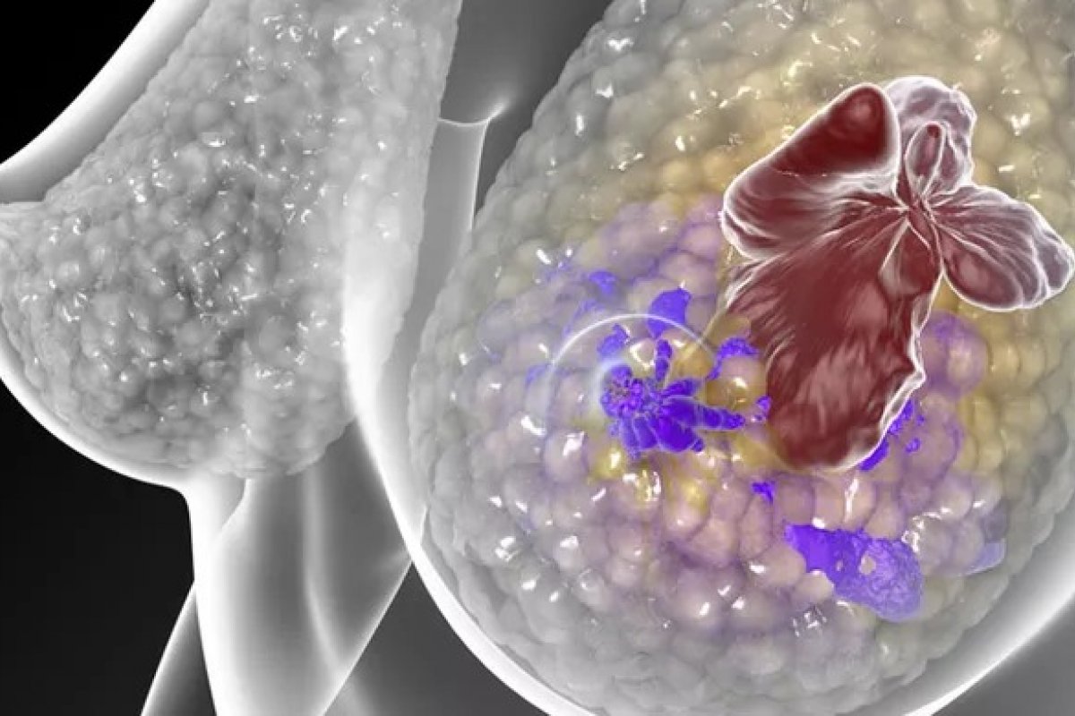 Câncer de mama: tratamento pode eliminar totalmente a doença em estágio inicial