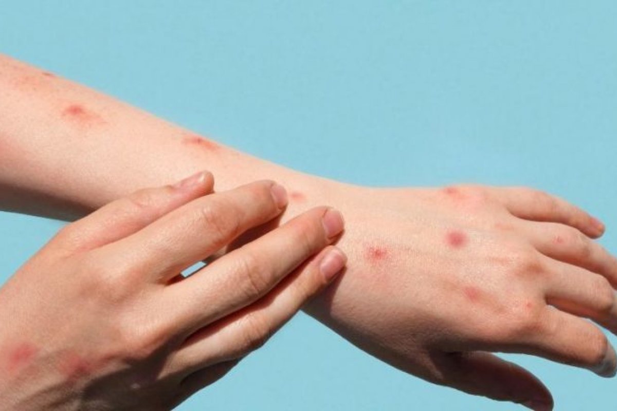 Butantan cria comitê para analisar produção de vacina contra varíola dos macacos