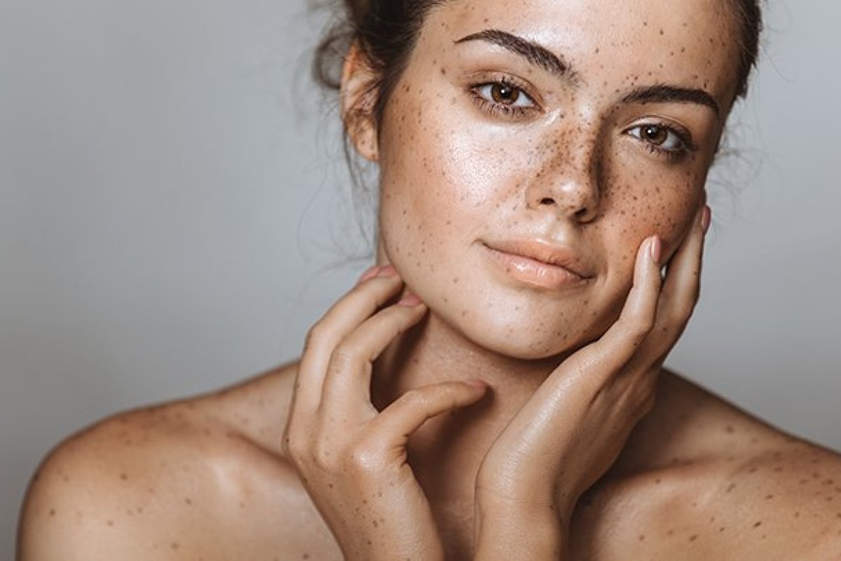 Tratamento evita o retorno do melasma