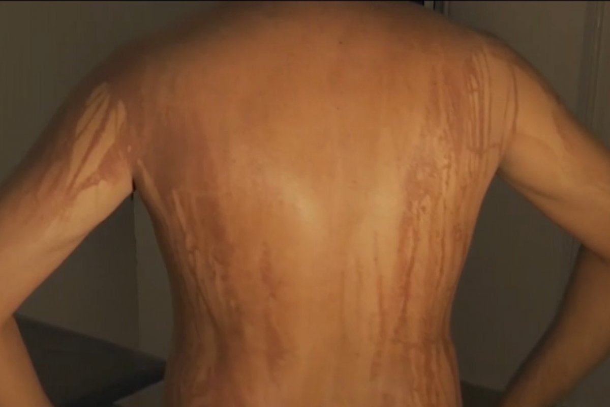 Turista que teve manchas no corpo após banho de mar na Bahia é internado