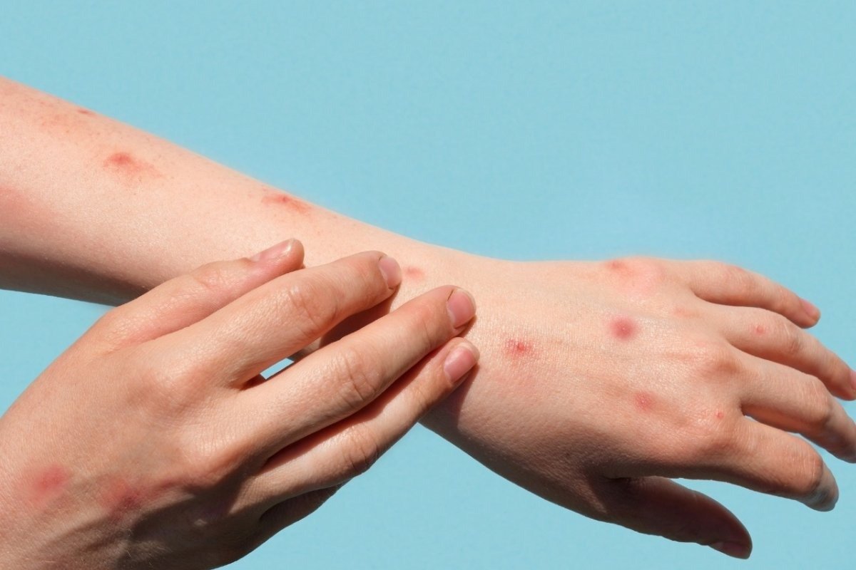 Varíola dos Macacos: Bahia passa a ter 13 casos em investigação