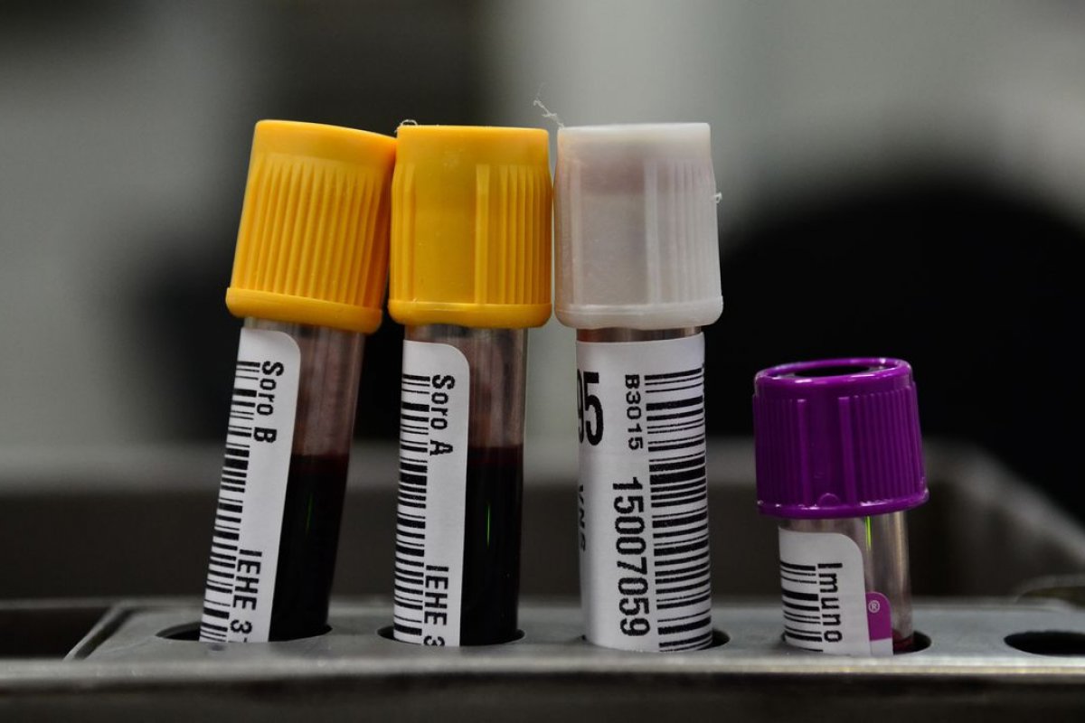 Paciente com HIV que recebeu células-tronco é declarado curado