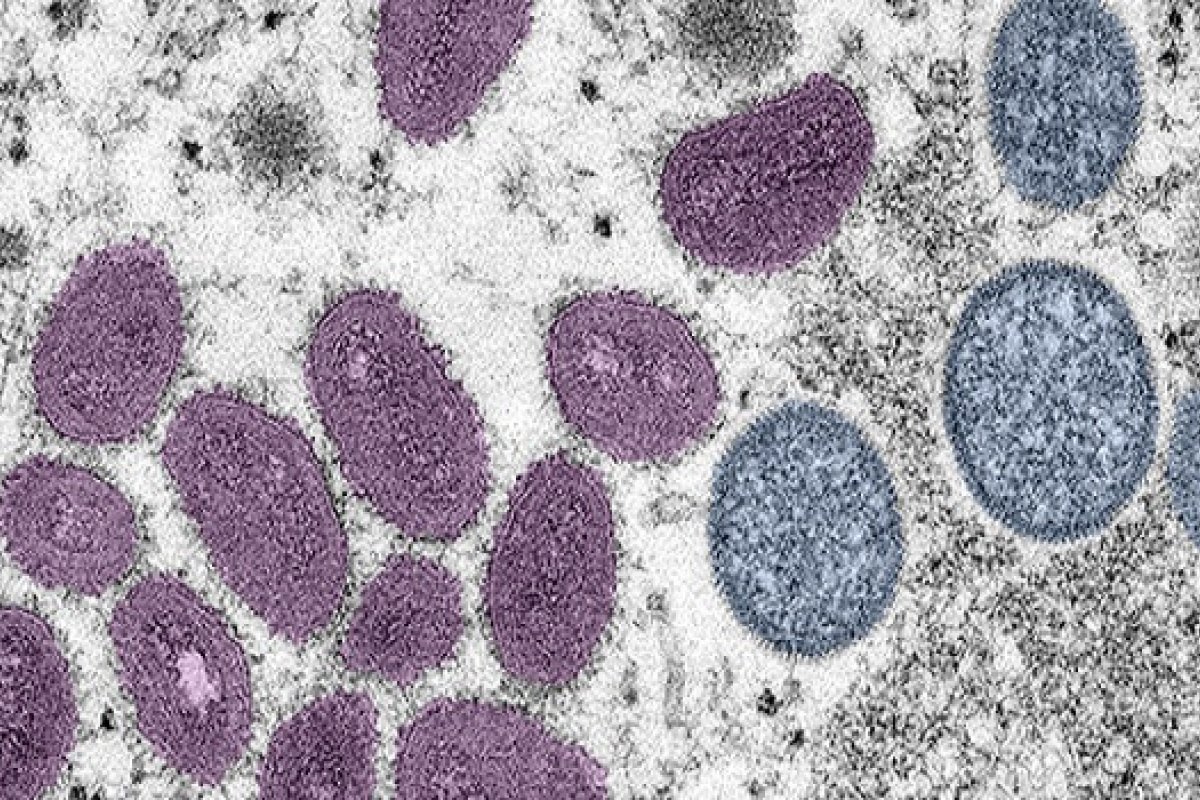 Primeira vítima da Monkeypox no Brasil tinha câncer, diz Ministério da Saúde