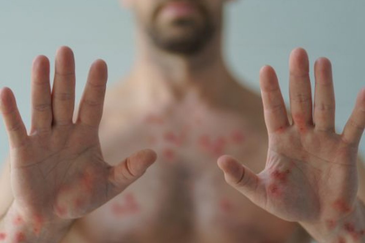 Podcast No Farol: varíola dos macacos