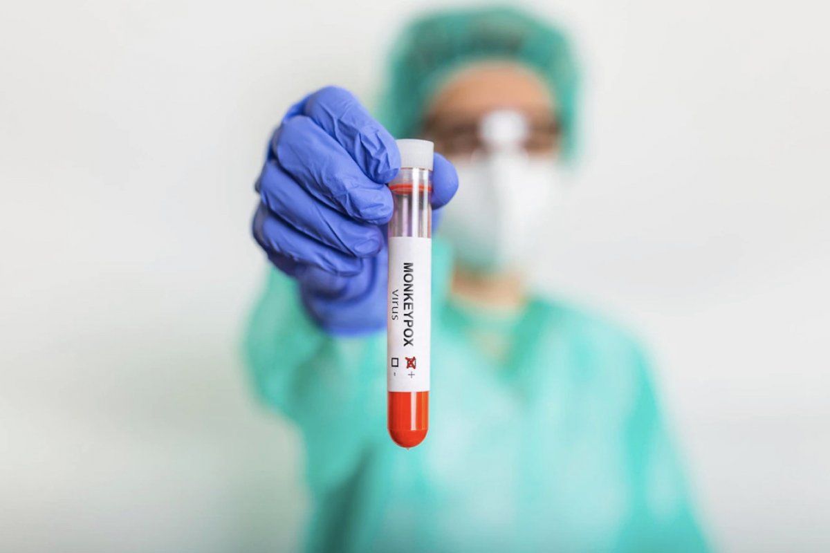 Segunda morte por varíola dos macacos é registrada na Espanha