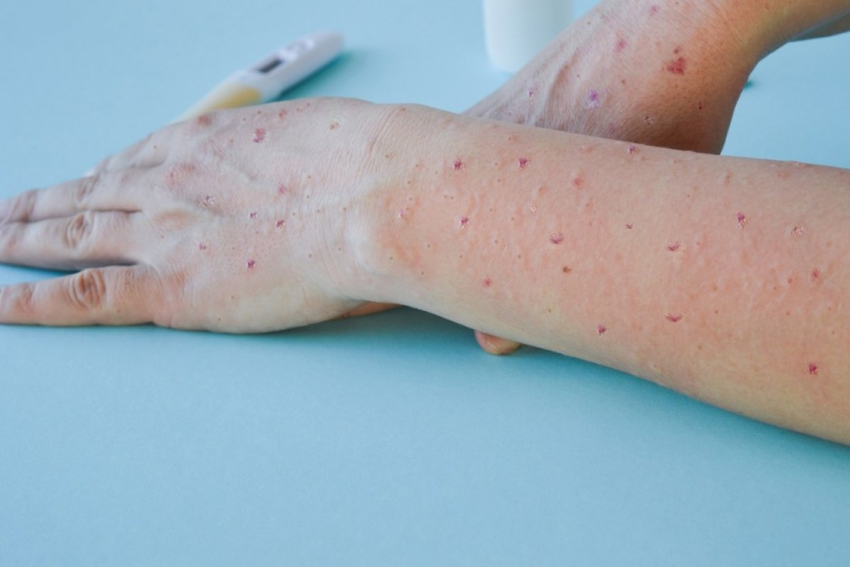 Brasil registra 1.369 casos de varíola dos macacos; confira como ocorre a transmissão