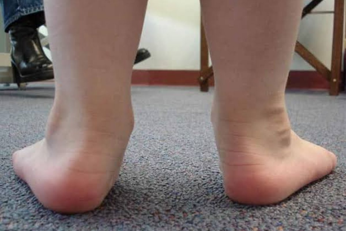 Pé chato em crianças a partir dos 7 anos deve ser avaliado por especialistas