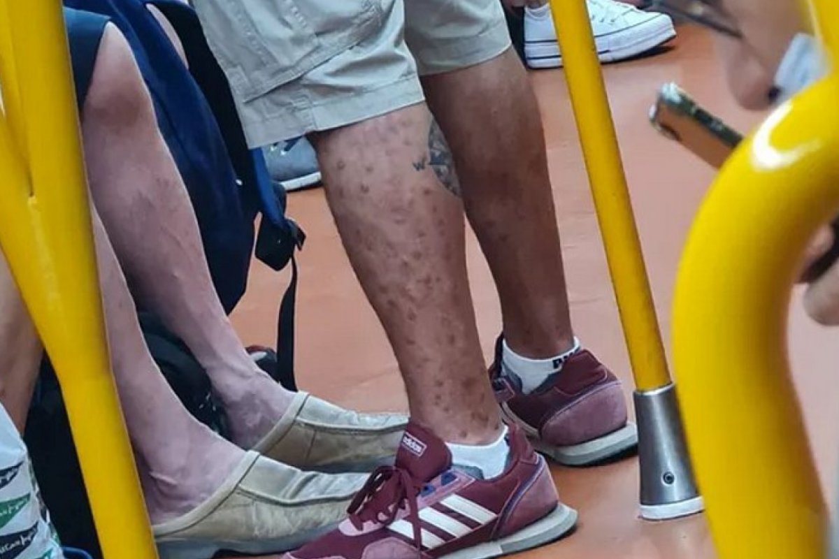 Médico flagra homem com varíola dos macacos em metrô na Espanha