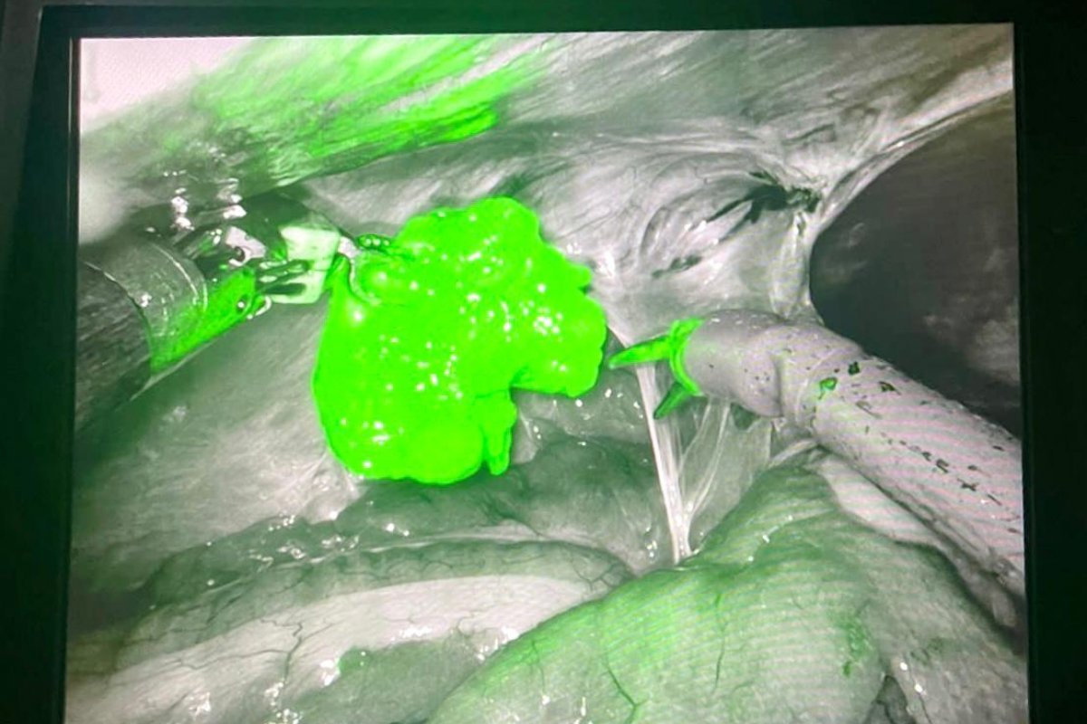 Tecnologias de última geração ajudam no tratamento do câncer de próstata com metástase linfática