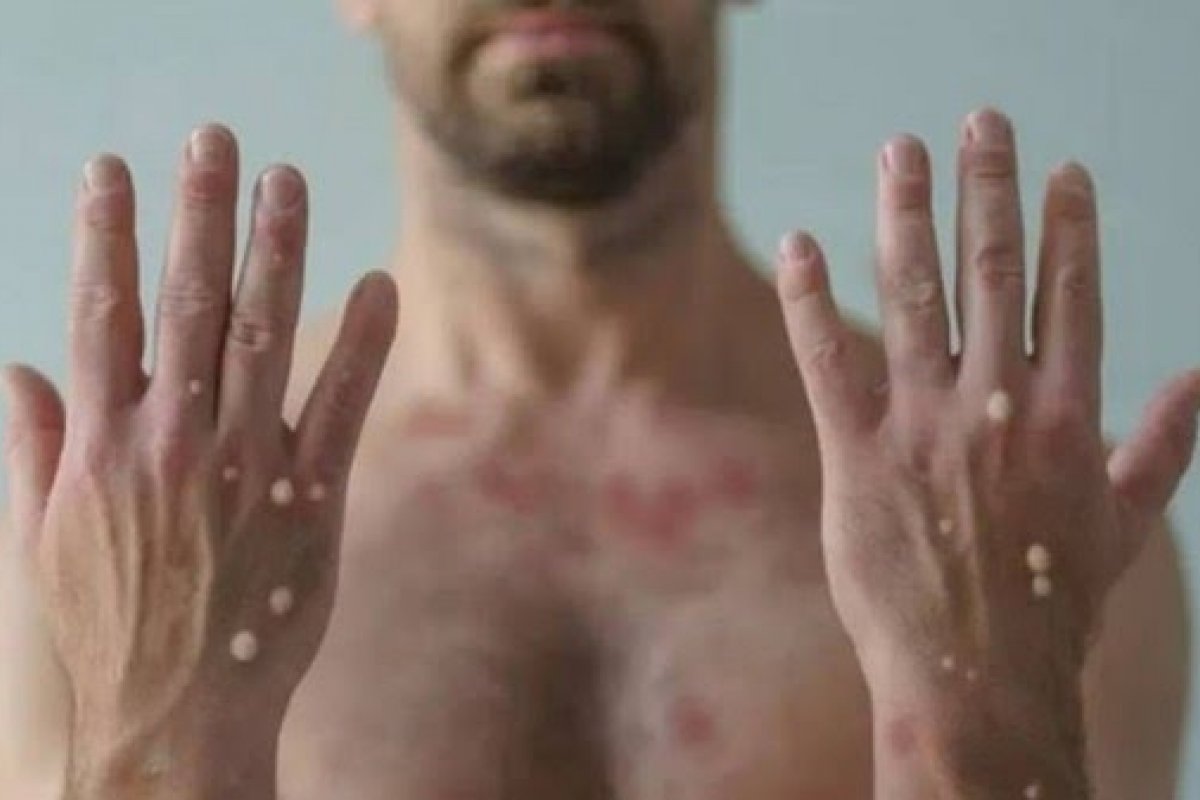 Mais um caso de varíola dos macacos é confirmado em Salvador