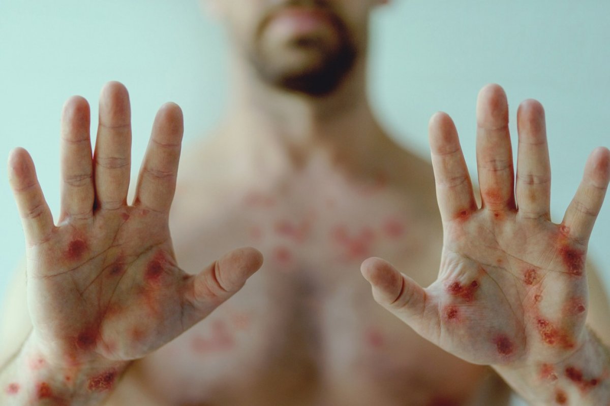 Varíola dos macacos: descubra novos sintomas e quais são os mais comuns