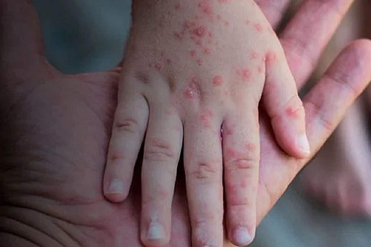 Mais três casos de varíola dos macacos são confirmados na Bahia