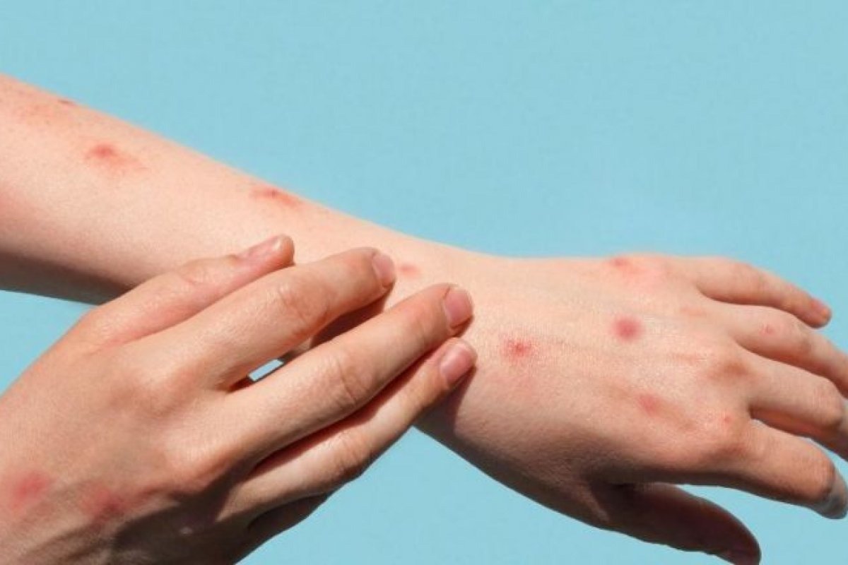 Varíola dos Macacos: população LGBT+ teme estigmas ligados à transmissão