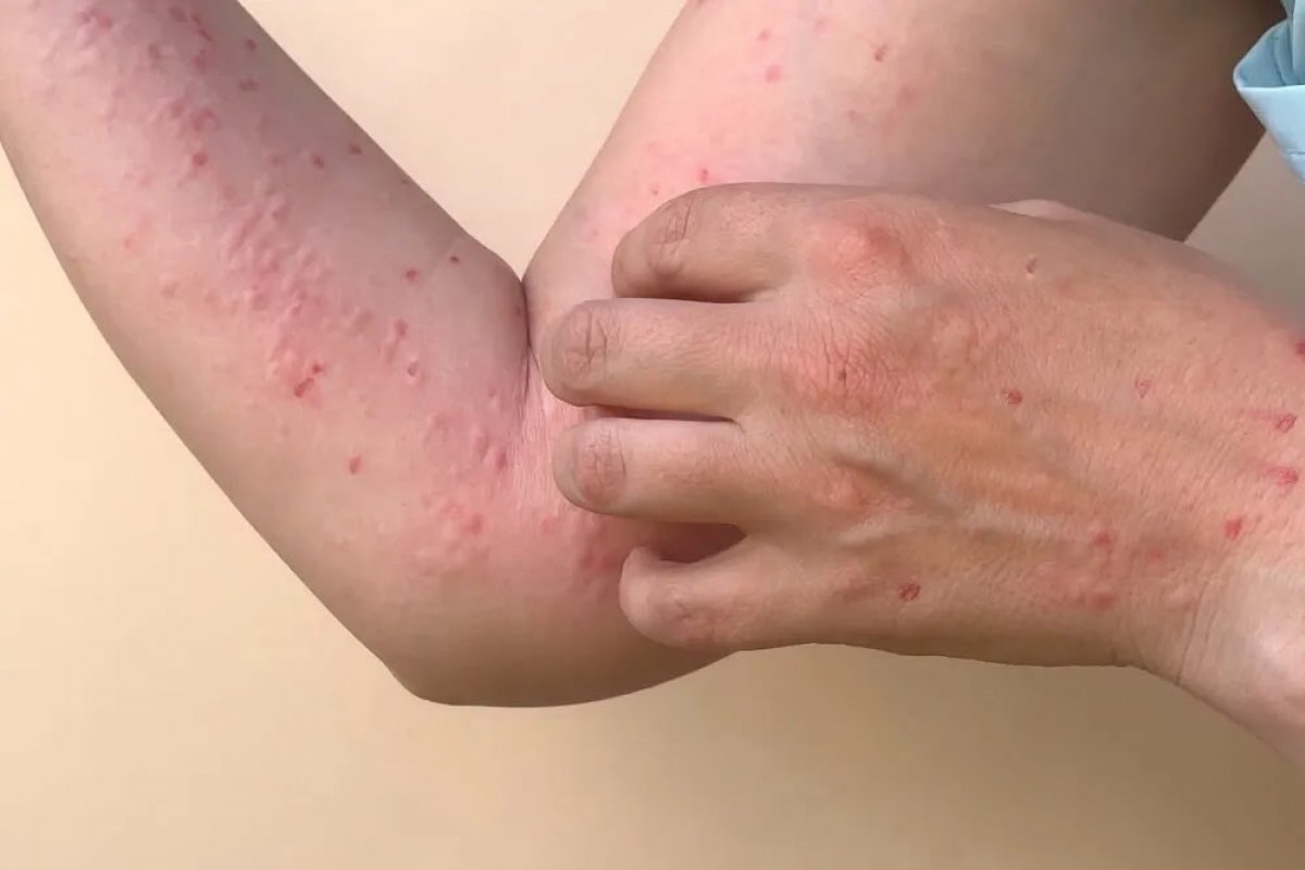 Secretaria de Saúde de Xique-Xique confirma 1º caso de varíola dos macacos na região