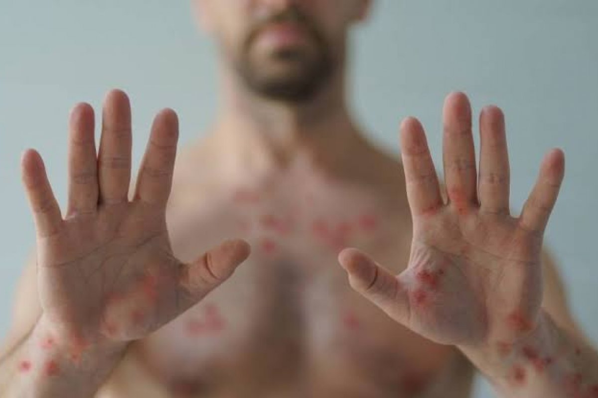 Anvisa abre consulta pública sobre venda de álcool 70% para prevenção da varíola dos macacos