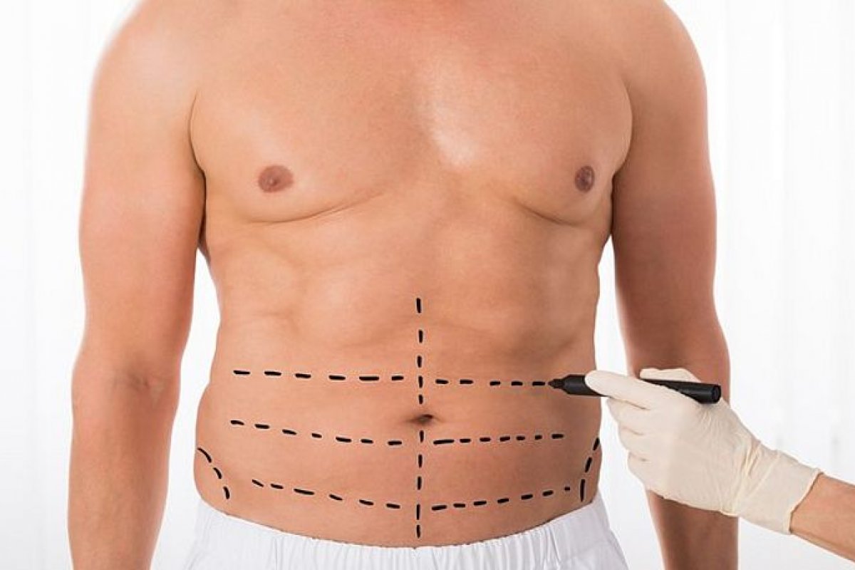 Lipo LAD em homens: a busca cada vez maior pela estética