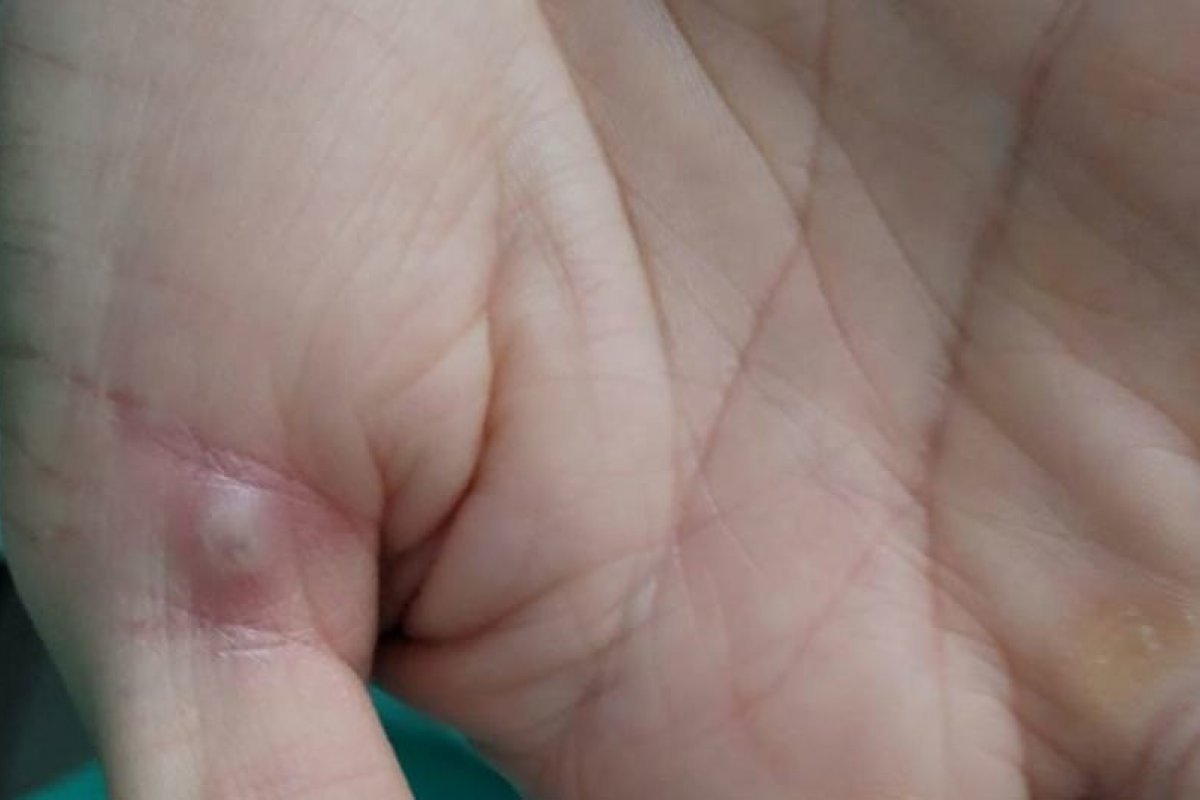 Monkeypox: OMS afirma que surto da doença na Europa deve acabar em breve