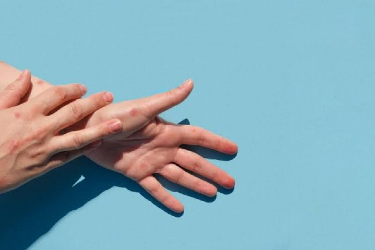 Mais dois casos de varíola dos macacos são confirmados na Bahia